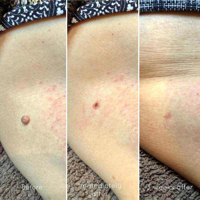 Skin tag removal before and after picture